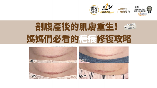剖腹產後的肌膚重生!媽媽們必看的疤痕修復攻略