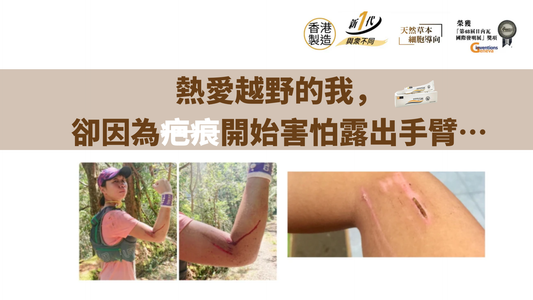 熱愛越野的我,卻因為疤痕開始害怕露出手臂…