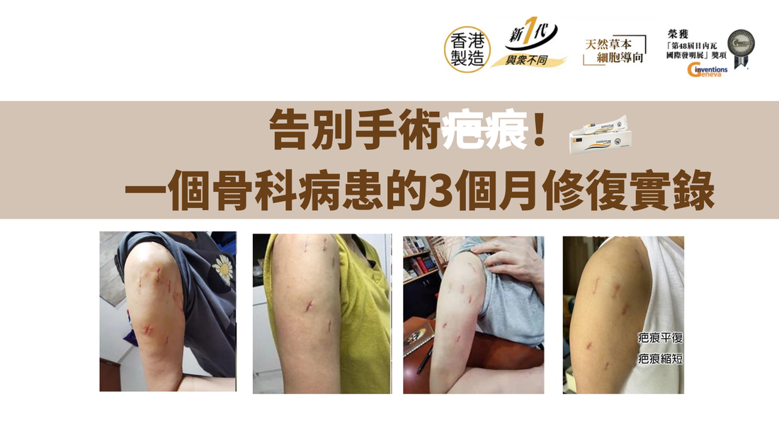 告別手術疤痕！一個骨科病患的3個月修復實錄