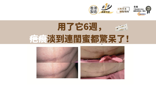 用了它6週， 疤痕淡到連閨蜜都驚呆了！