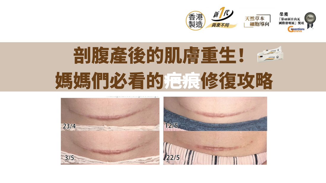 剖腹產後的肌膚重生！媽媽們必看的疤痕修復攻略