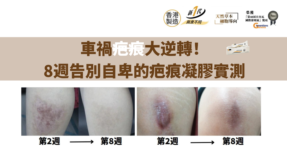 車禍疤痕大逆轉！8週告別自卑的疤痕凝膠實測