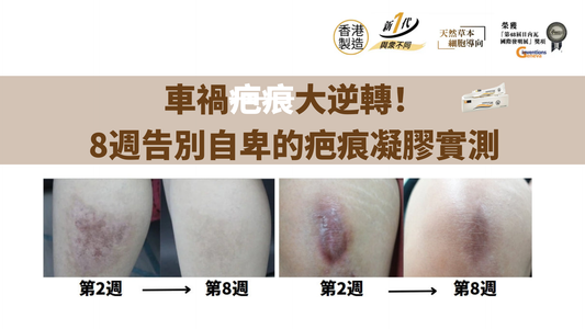 車禍疤痕大逆轉！8週告別自卑的疤痕凝膠實測