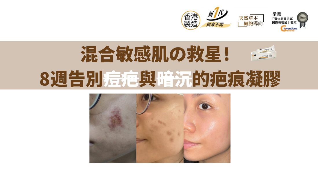 混合敏感肌の救星！8週告別痘疤與暗沉的疤痕凝膠