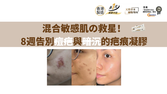 混合敏感肌の救星！8週告別痘疤與暗沉的疤痕凝膠