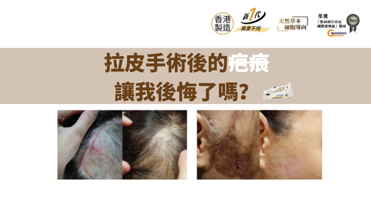 拉皮手術後的疤痕，讓我後悔了嗎？