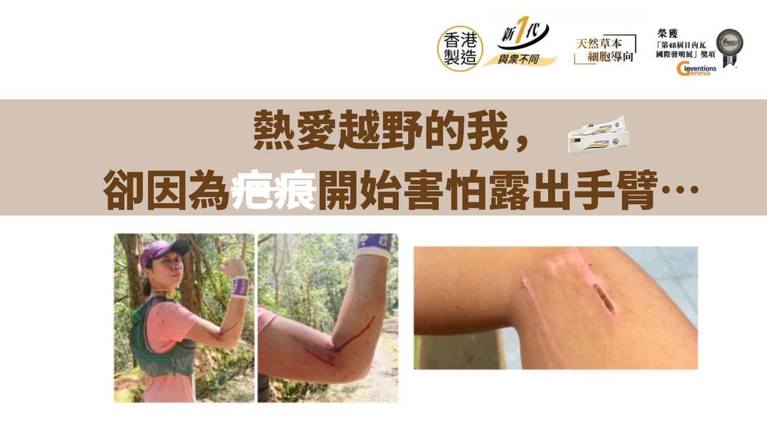 熱愛越野的我，卻因為疤痕開始害怕露出手臂…